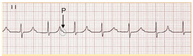 First-degree AC block ECG.