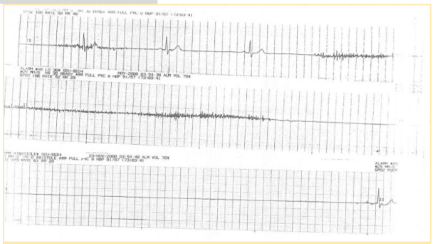 ECG interpretation per question.