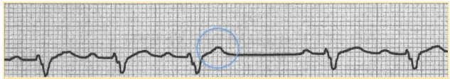 Blocked contraction hidden at preceding t wave, not followed by QRS complex, and followed by compensatory pause.