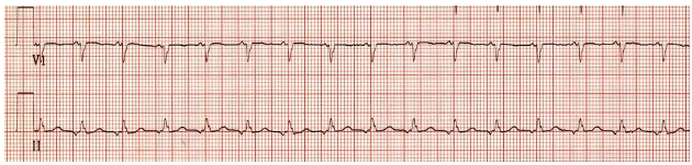 Abnormal P wave morphology with positive deflection in lead V1 and negative deflection in lead II.