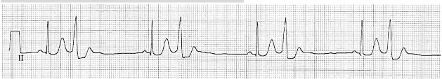 Bigeminy of premature ventricular complexes ECG.