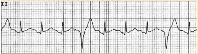 Premature ventricular complex precedes three sinus rhythm complexes.