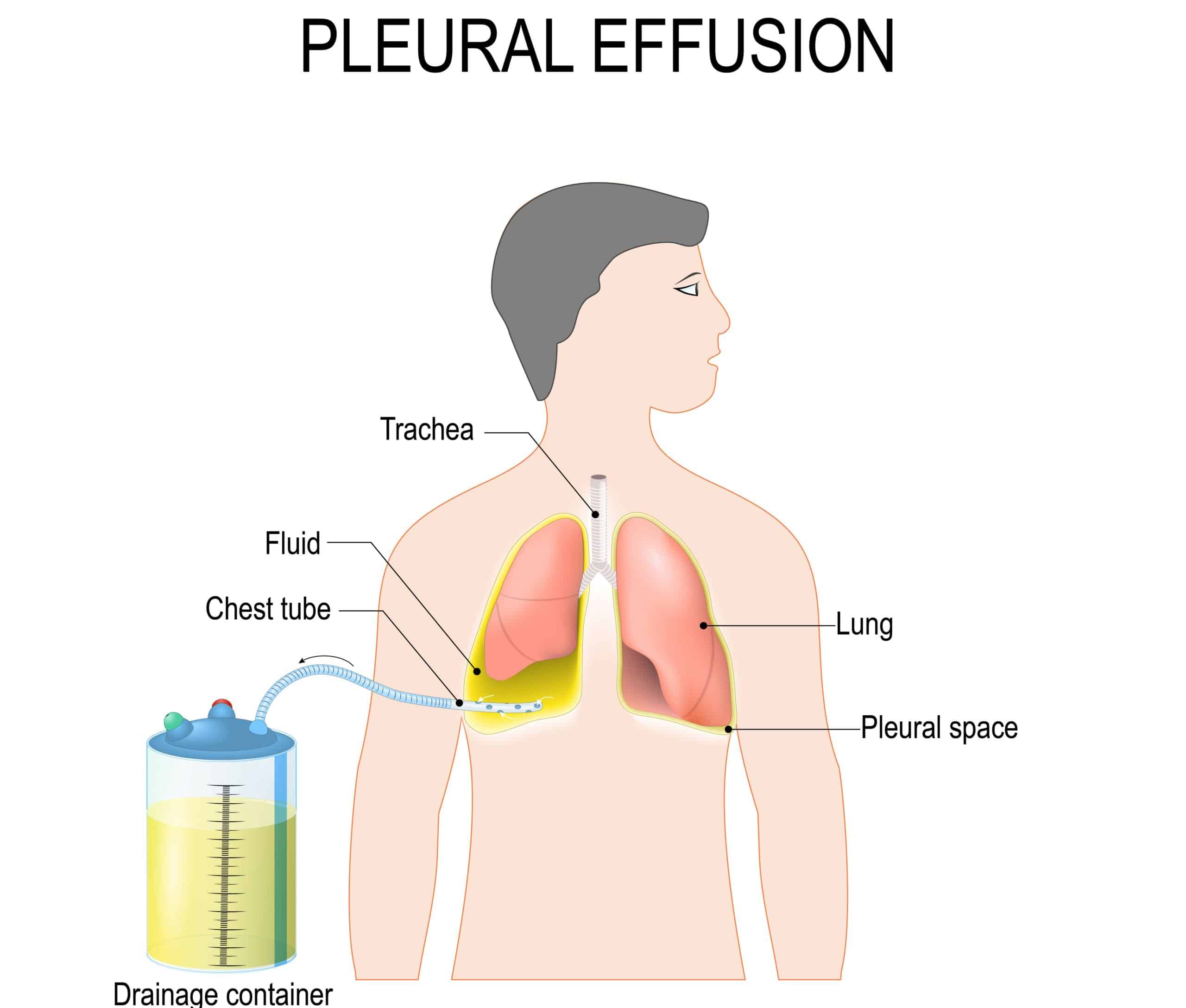 A chest tube drains liquid from a pleural effusion - diagram of chest tube and the human body.