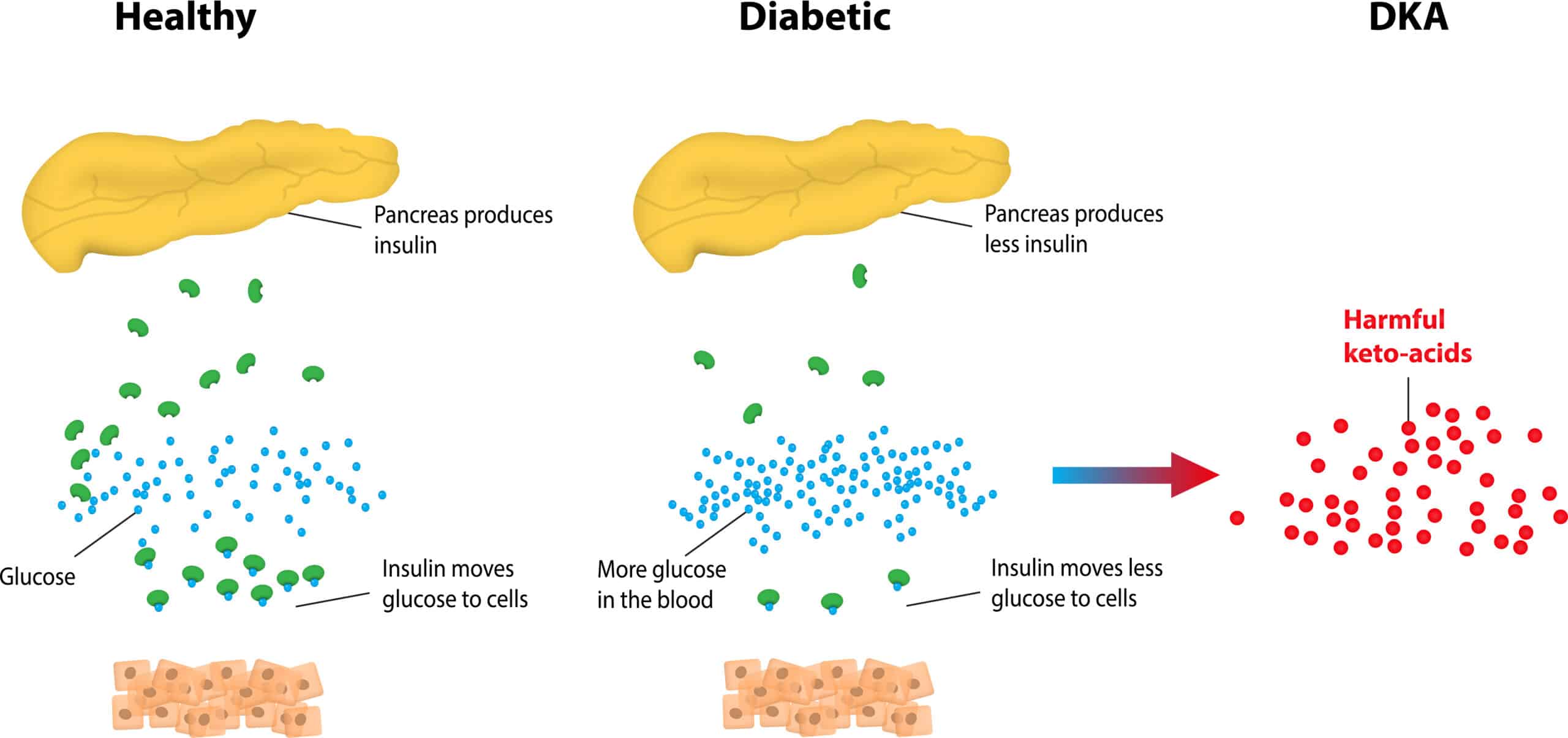 Fats break down into keto acids during diabetic ketoacidosis.