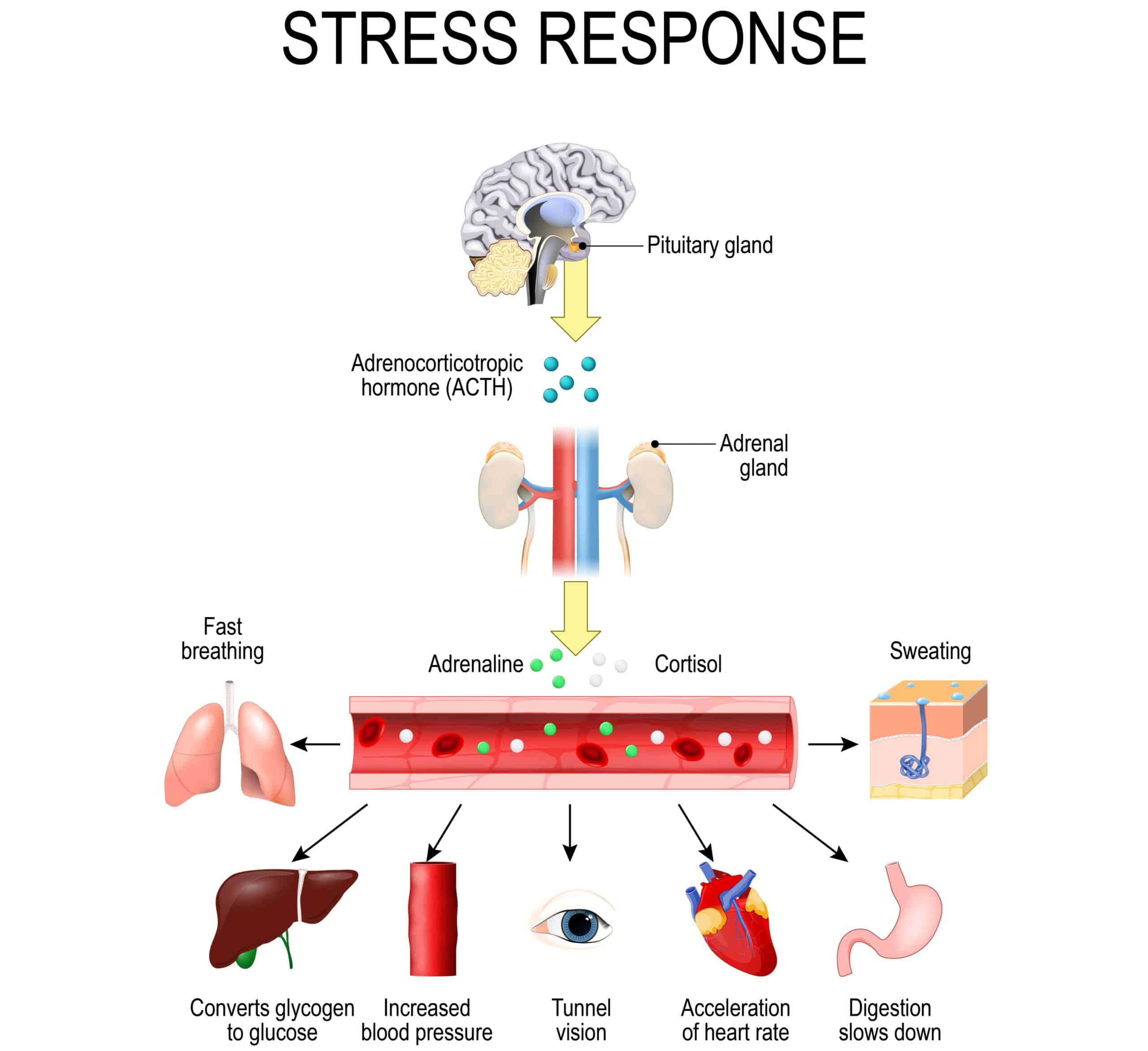 Stress response diagram - Hyperosmolar hyperglycemic syndrome.