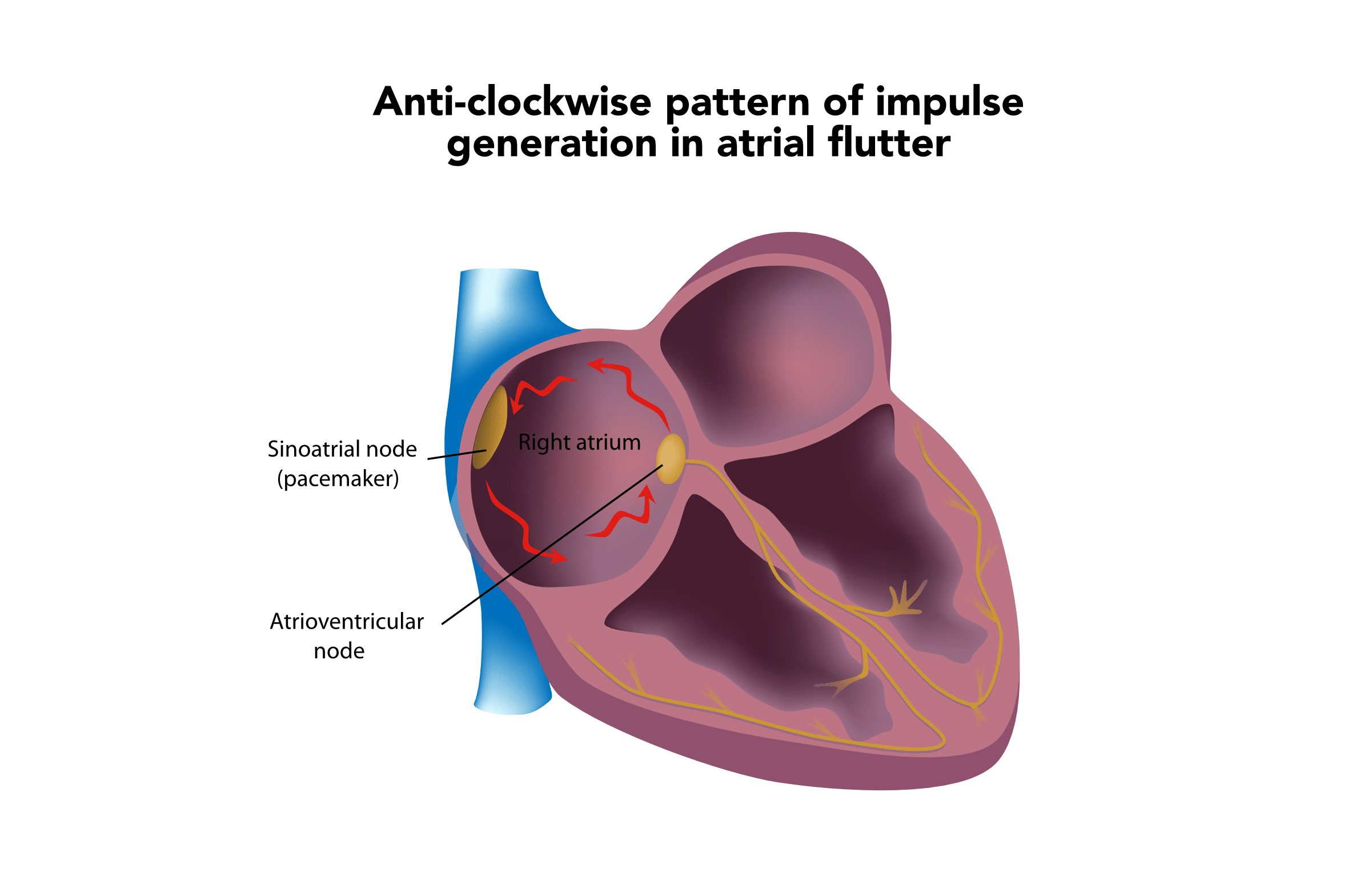 Anti-clockwise pattern of impulse generation in atrial flutter - diagram of the heart.