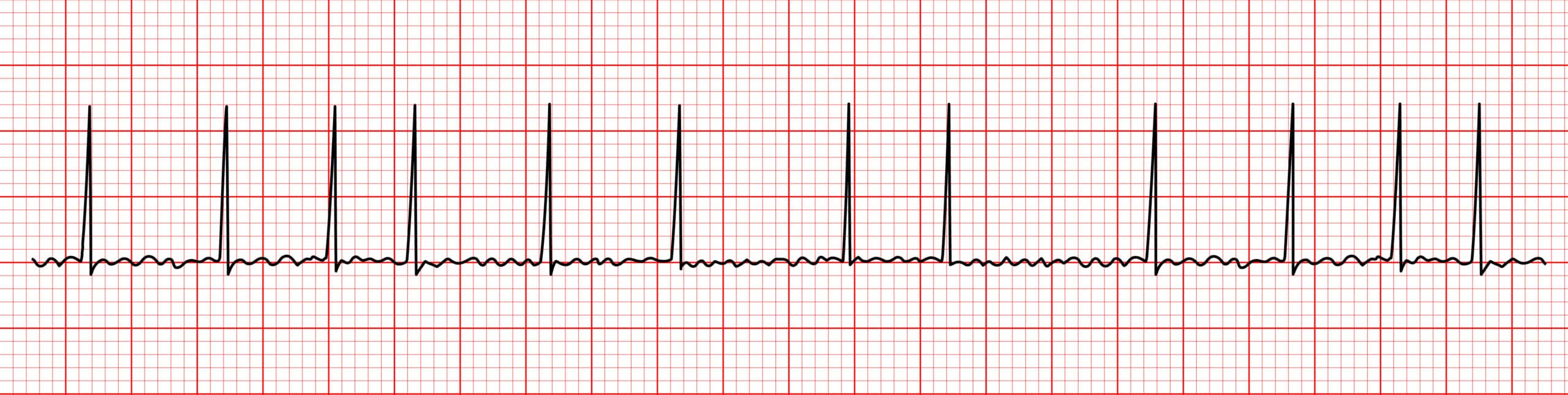 Atrial fibrillation and irregular R-R interval - ECG tracing.