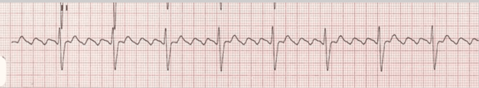 A 3:1 block with an atrial rate of 250 bpm and a ventricular rate of 65 bpm – ECG tracing.