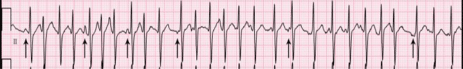 Multifocal atrial tachycardia (MAT) – ECG strip.