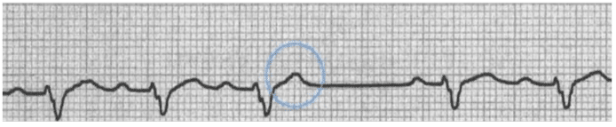 PAC with peaked T wave – ECG Tracing.