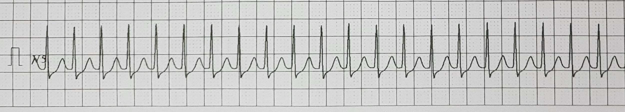 Supraventricular tachycardia – ECG tracing.