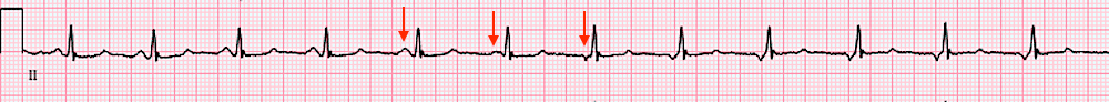 Wandering pacemaker ECG strip.