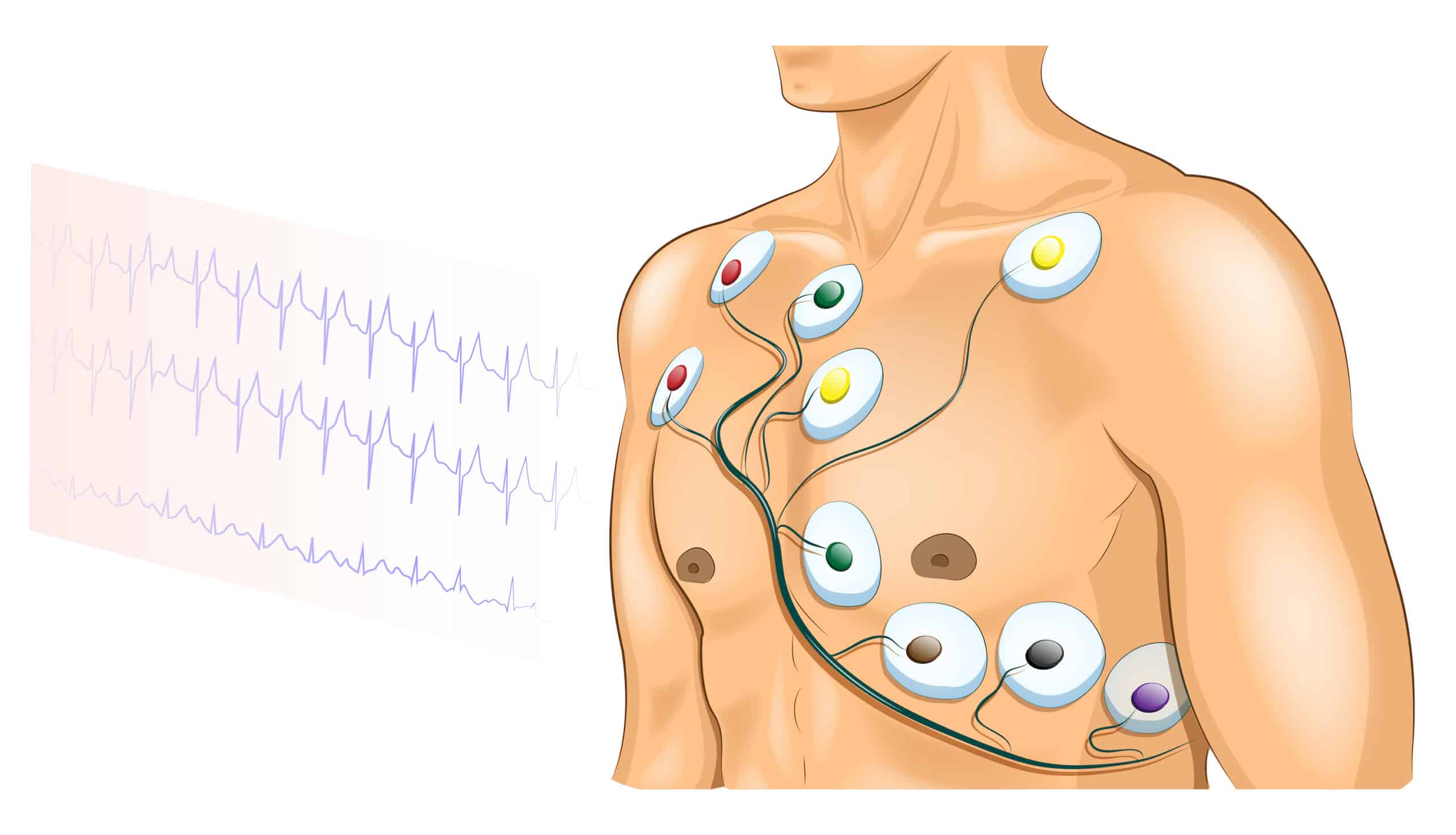 12 Lead ECG Attached Patient 12-lead ECG attached to patient.