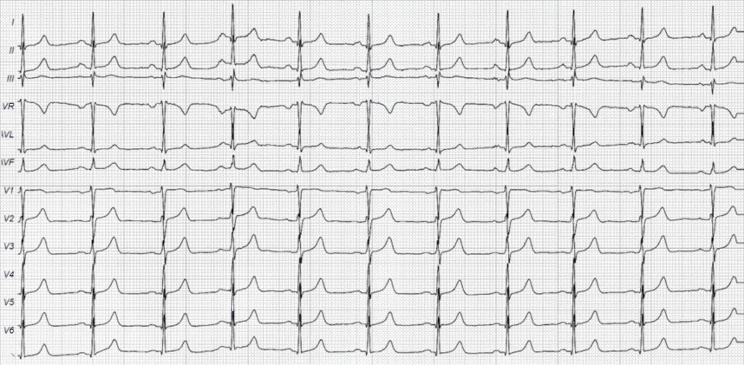 43-year-old woman with history of mitral stenosis ECG.