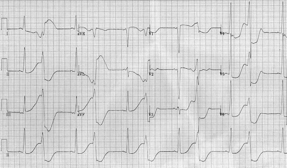 ECG representing R-on-T phenomenon.