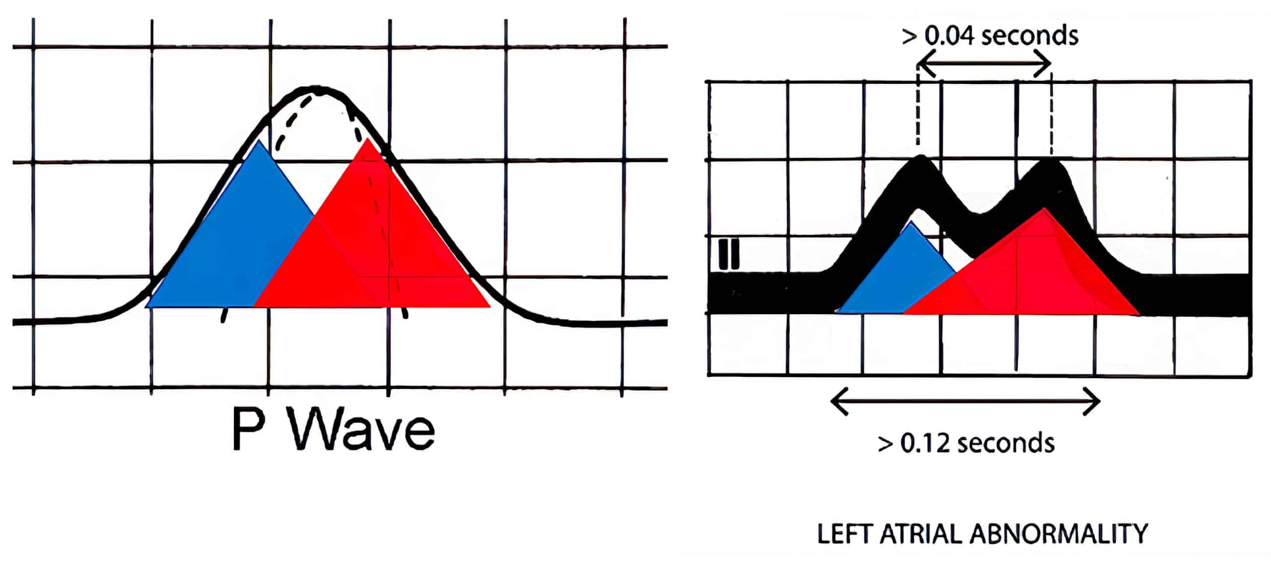 Normal P wave and bifidity.