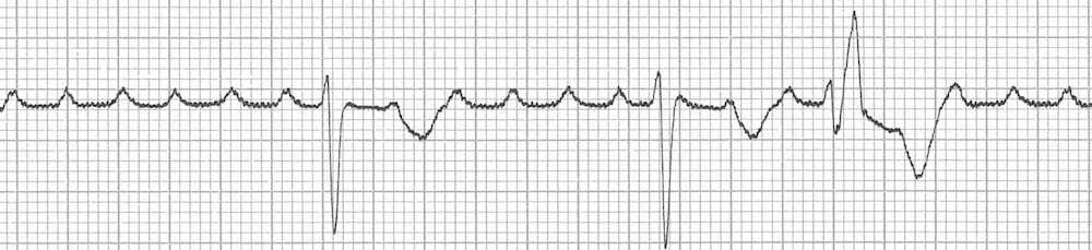 Paroxysmal atrial tachycardia with atrioventricular block ECG.