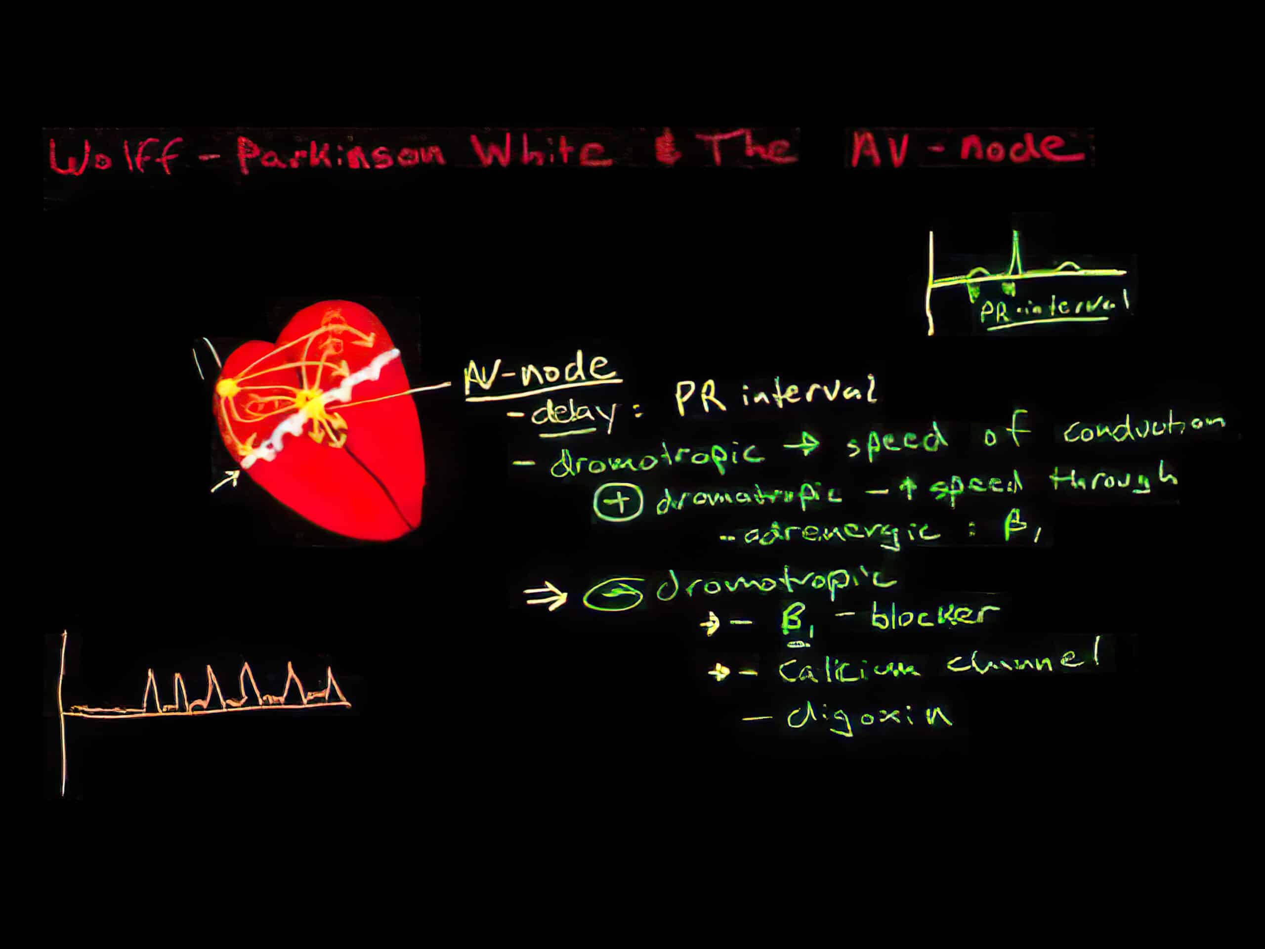 Pathophysiology of Wolff-Parkinson-White syndrome video.