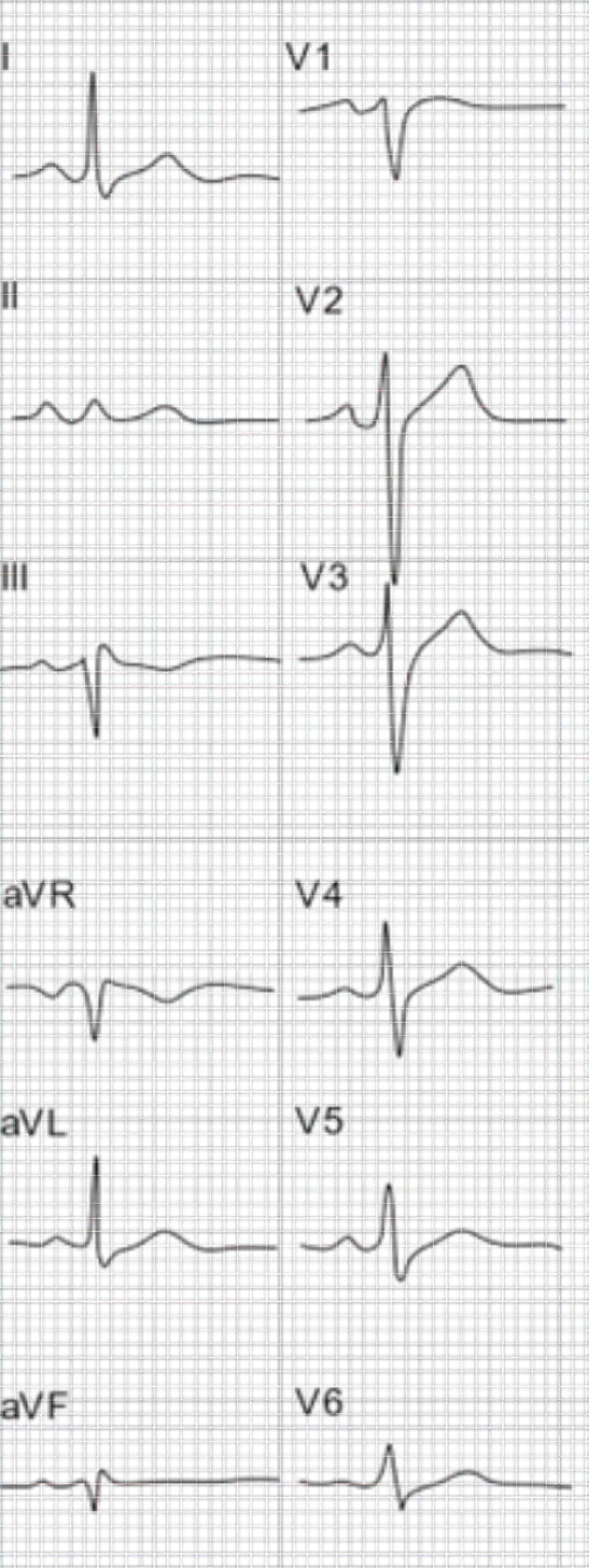Patient with primary hyperparathyroidism ECG.