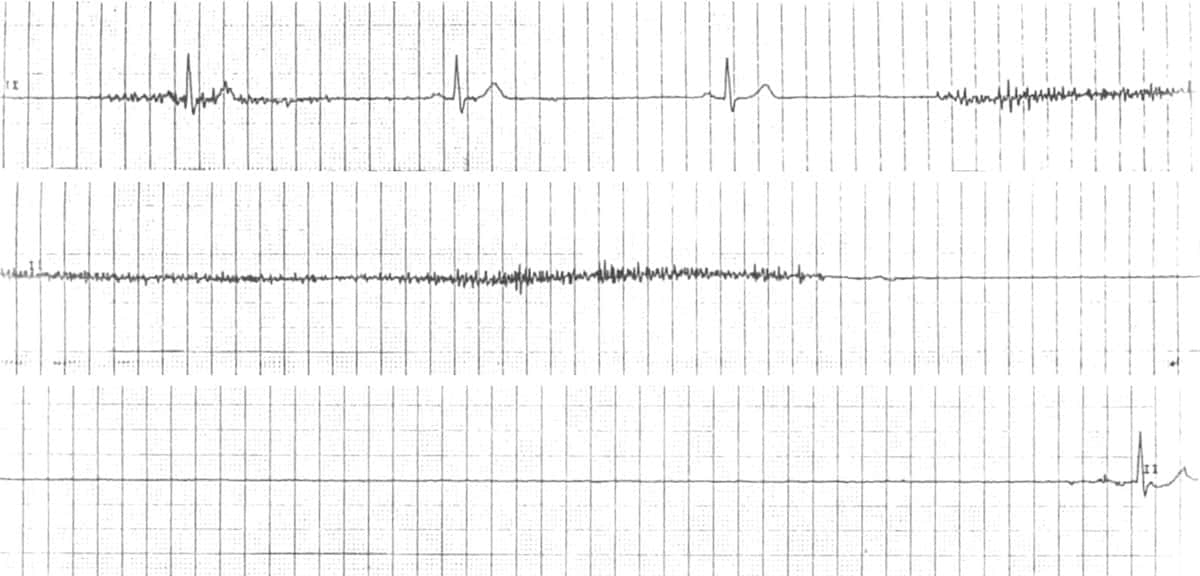 Sinus arrest ECG.
