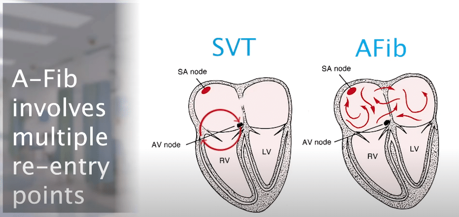 SVT and AF reentry pathways.