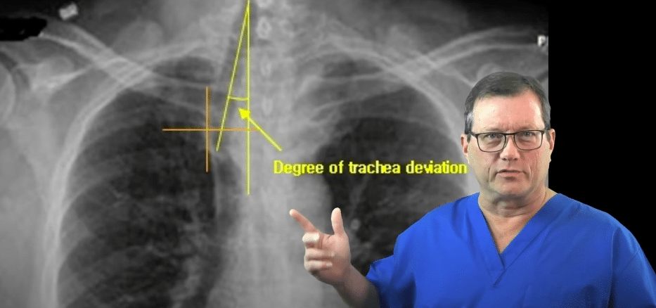 X-ray showing tracheal deviation.