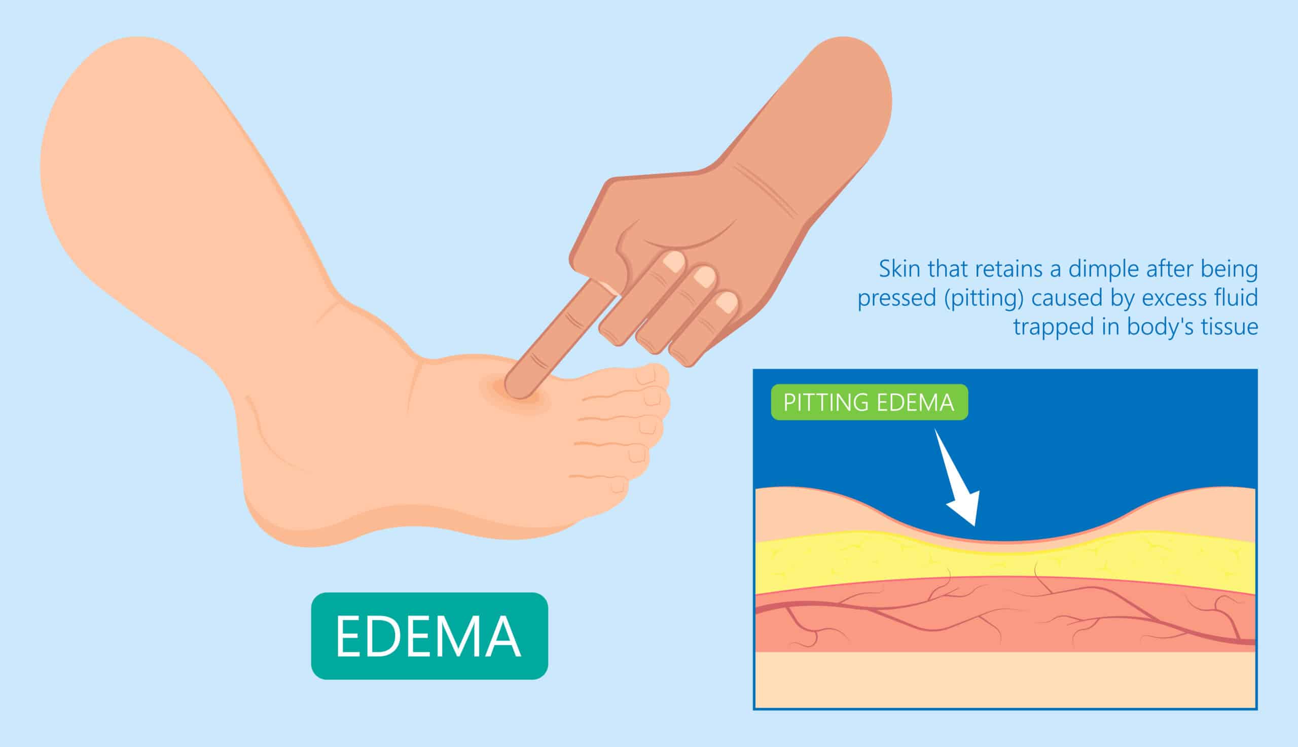 Edema is one of the signs of fluid volume overload - diagram explaining edema on the foot.