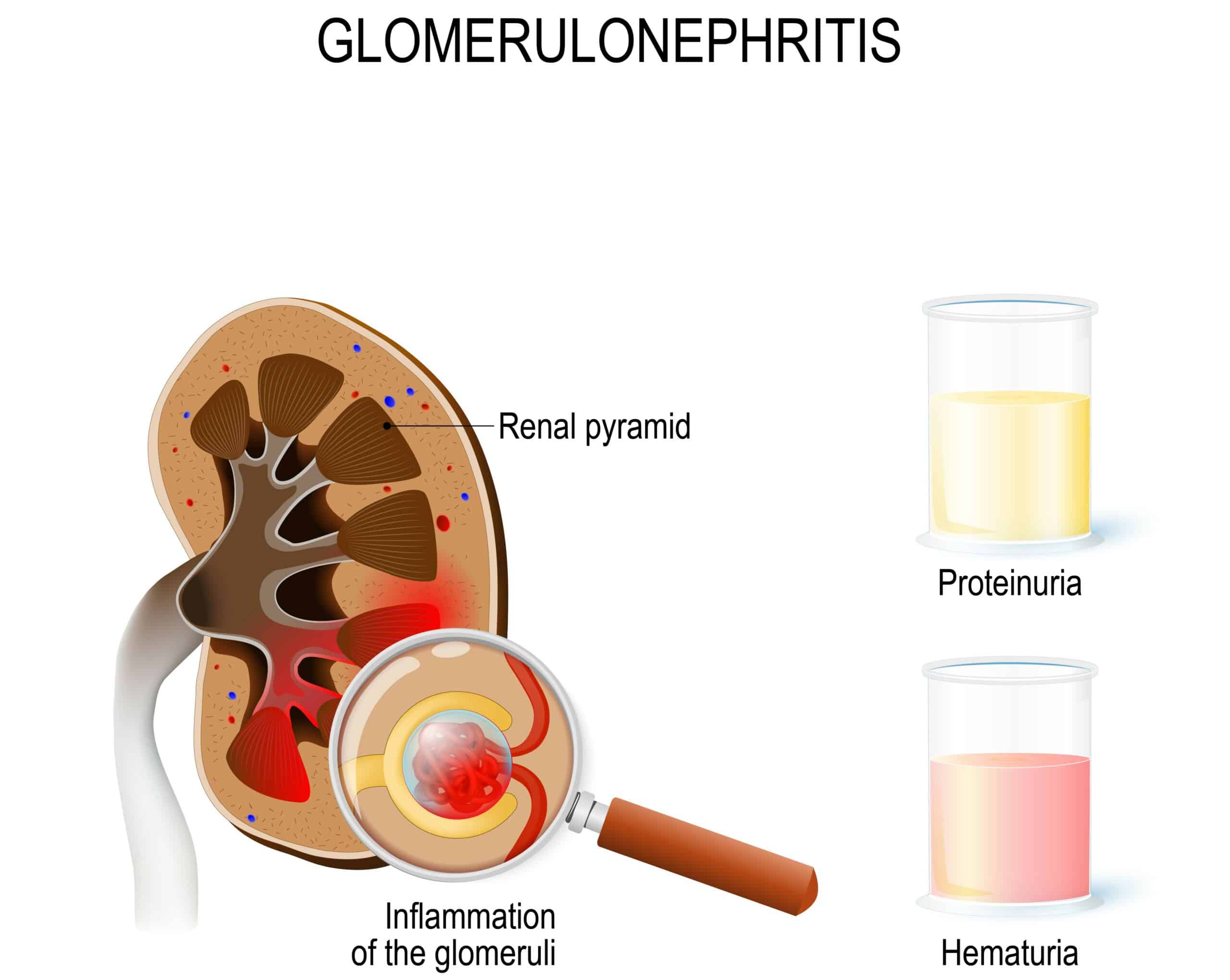 Glomerulonephritis - diagram explaining how it impacts the kidney.