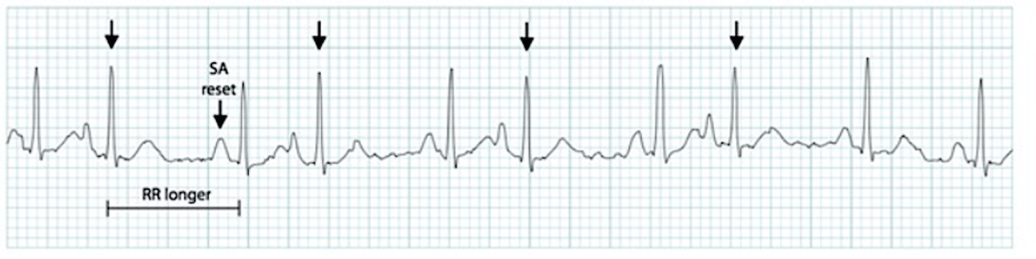 PAC ECG Tracing Premature atrial contraction (PAC) ECG tracing.