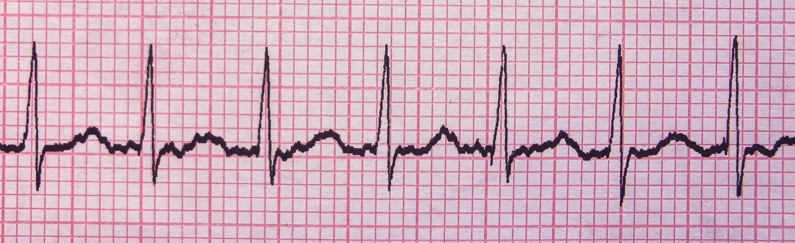 Supraventricular Tachycardia SVT ECG tracing interpretation.