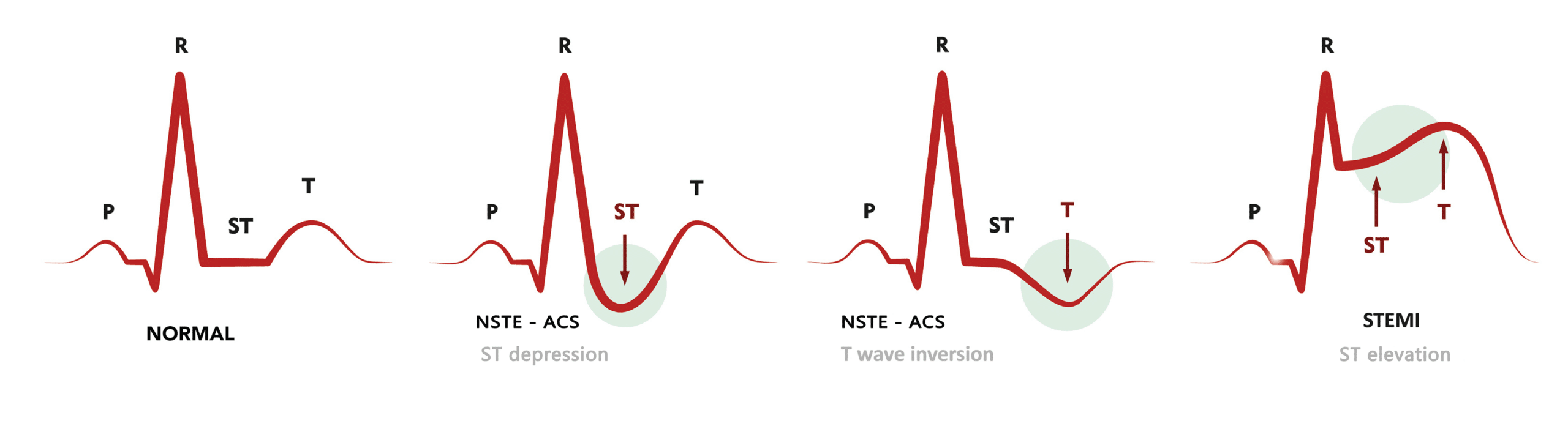 Acute Coronary Syndrome ECG Changes Acute coronary syndrome ECG changes.