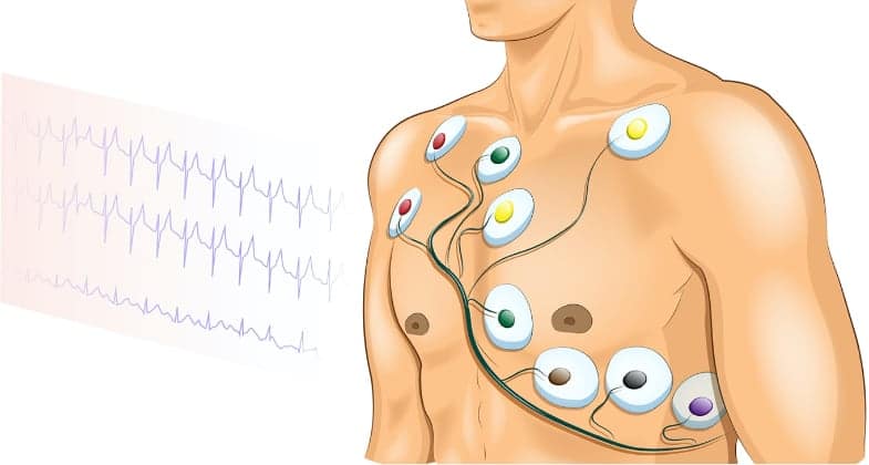Acquiring 12-lead ECG.