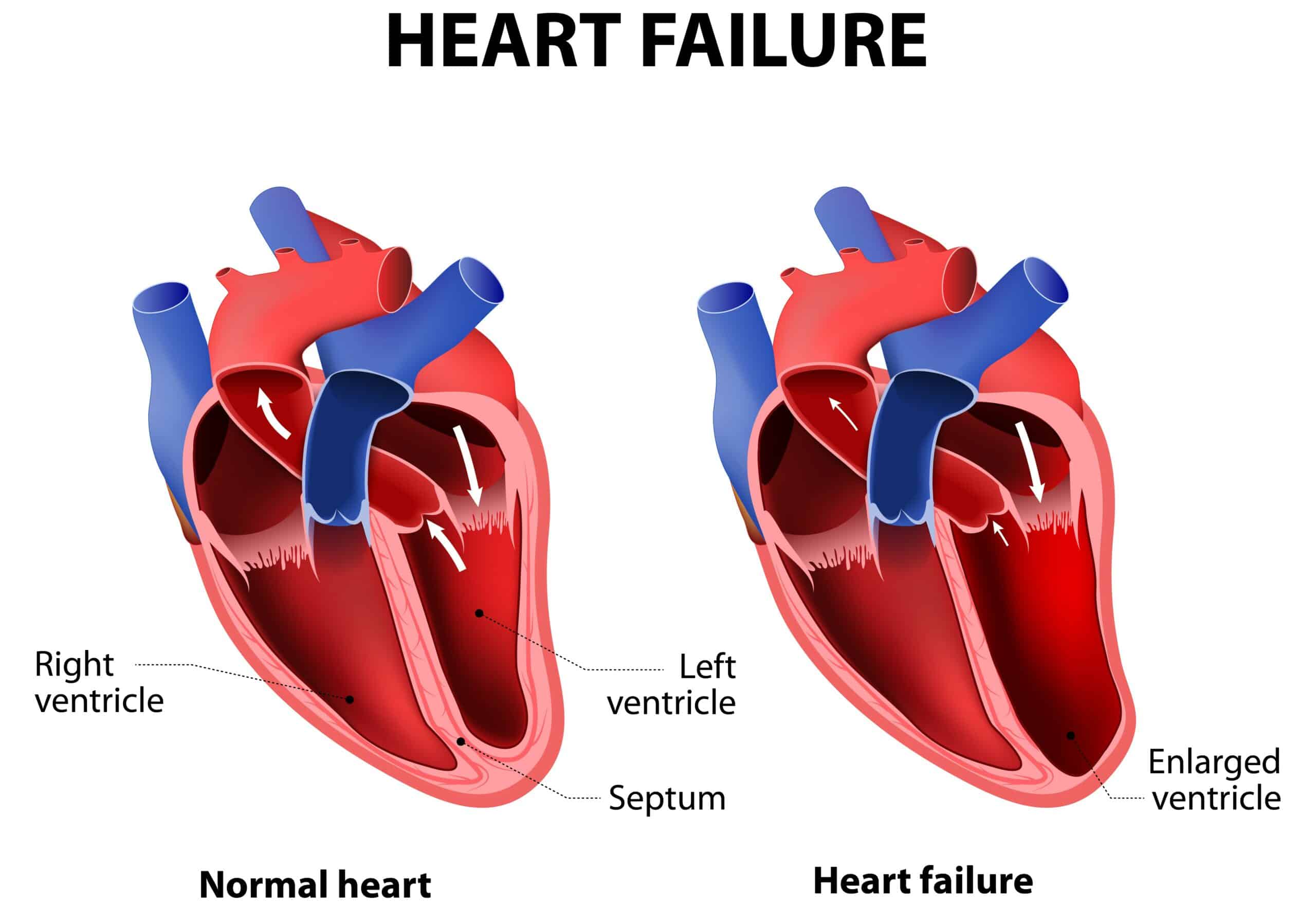 RAAS in congestive heart failure - diagram of the heart.