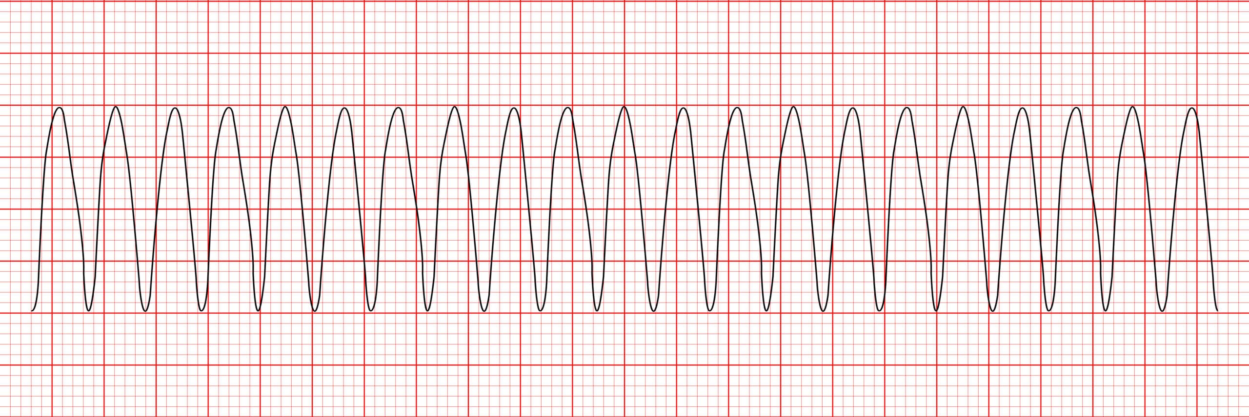 Monomorphic ventricular tachycardia - ECG tracing.