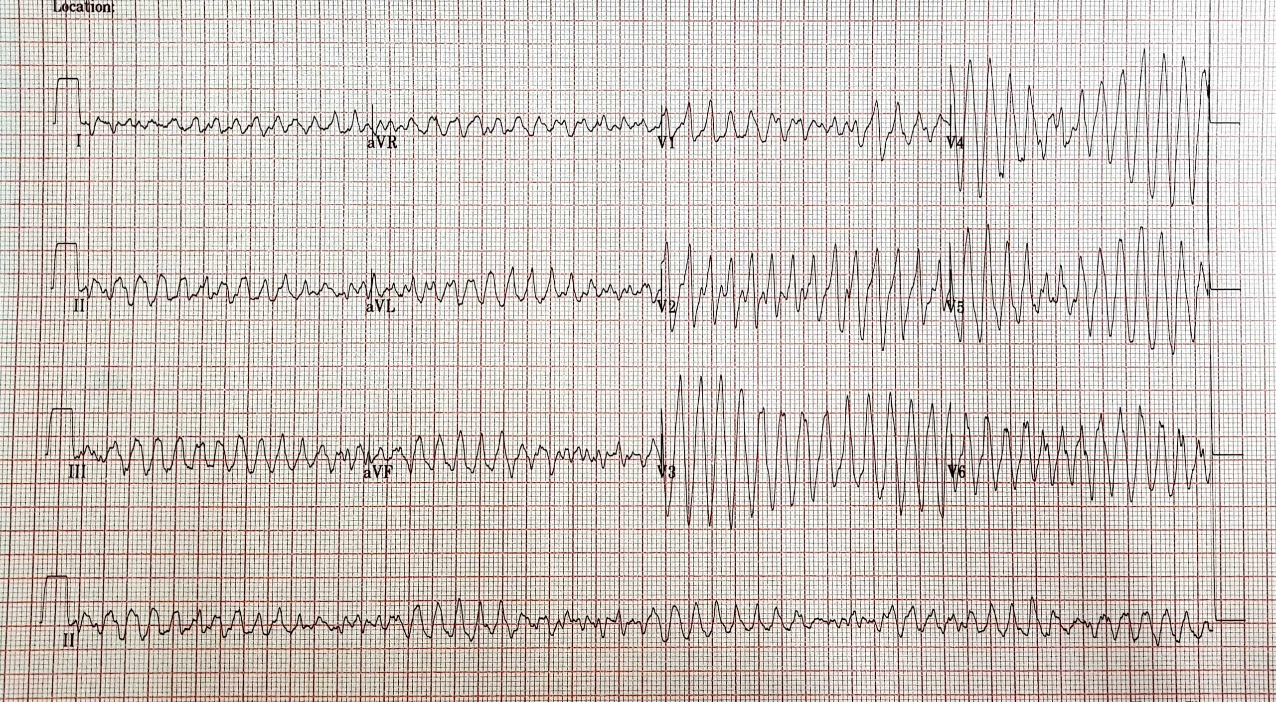 Polymorphic ventricular tachycardia – Torsades de Pointes.