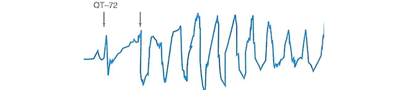 Polymorphic ventricular tachycardia - ECG tracing.