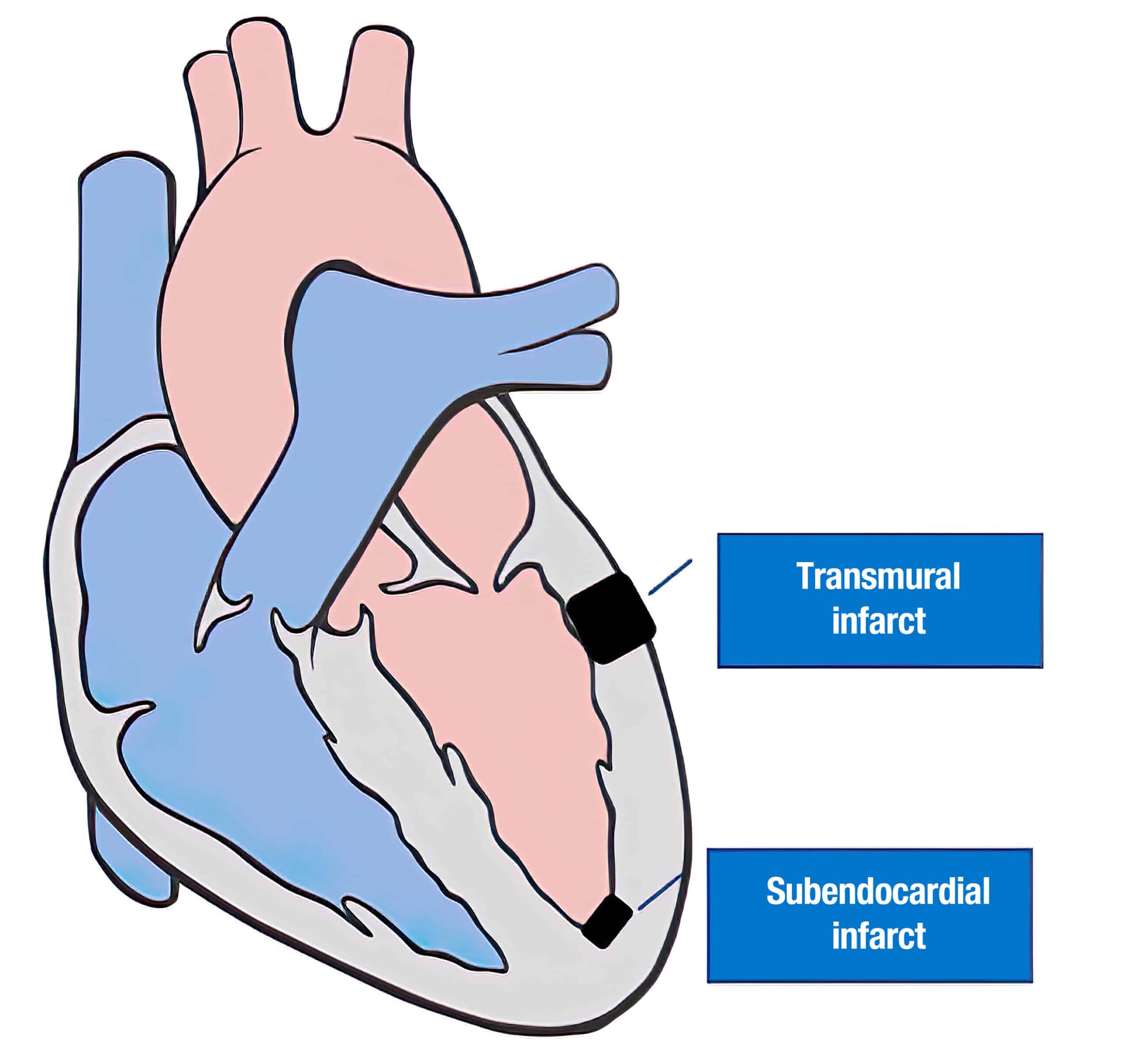 Cardiac infarct impact.