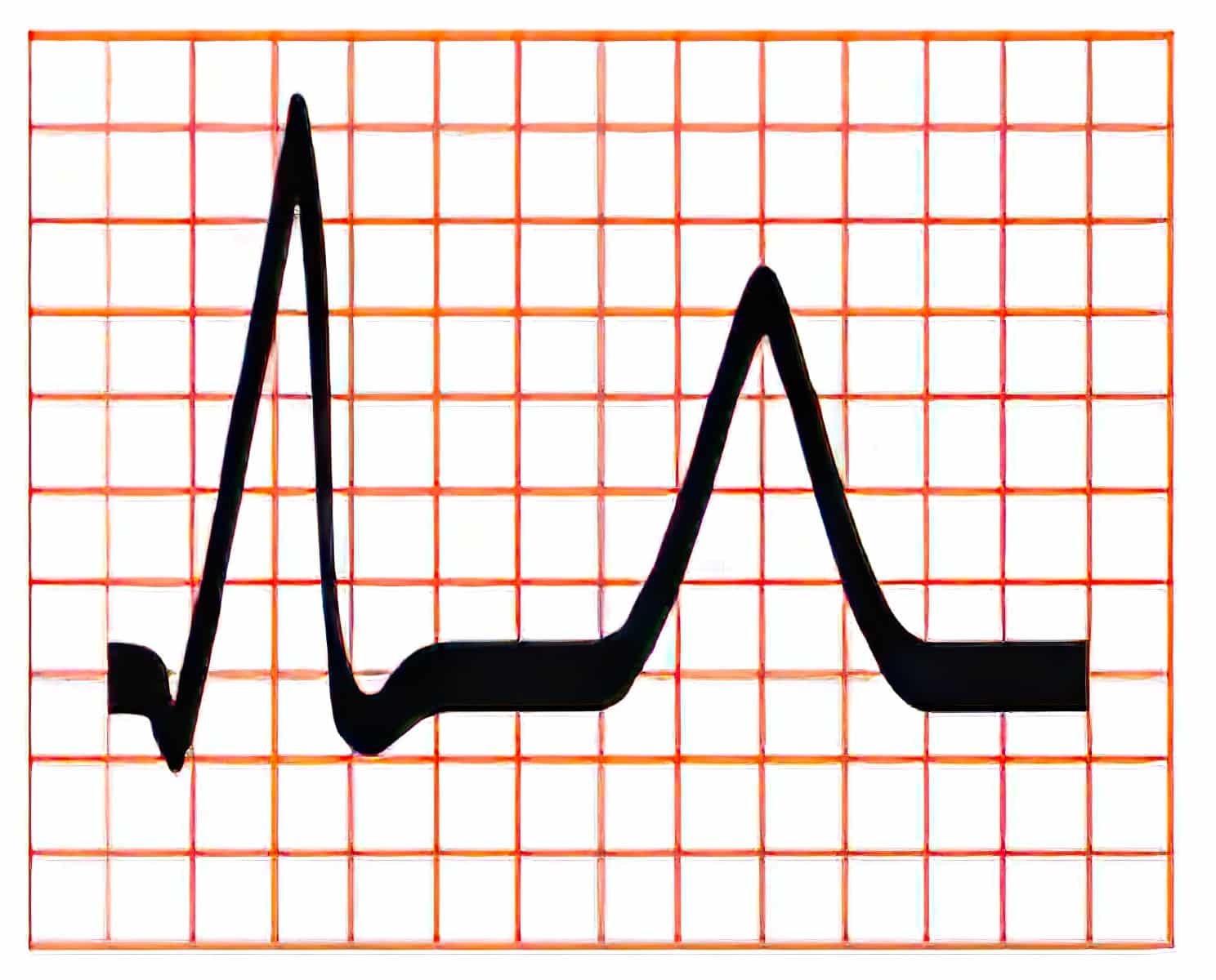 Subendocardial ischemia ECG.