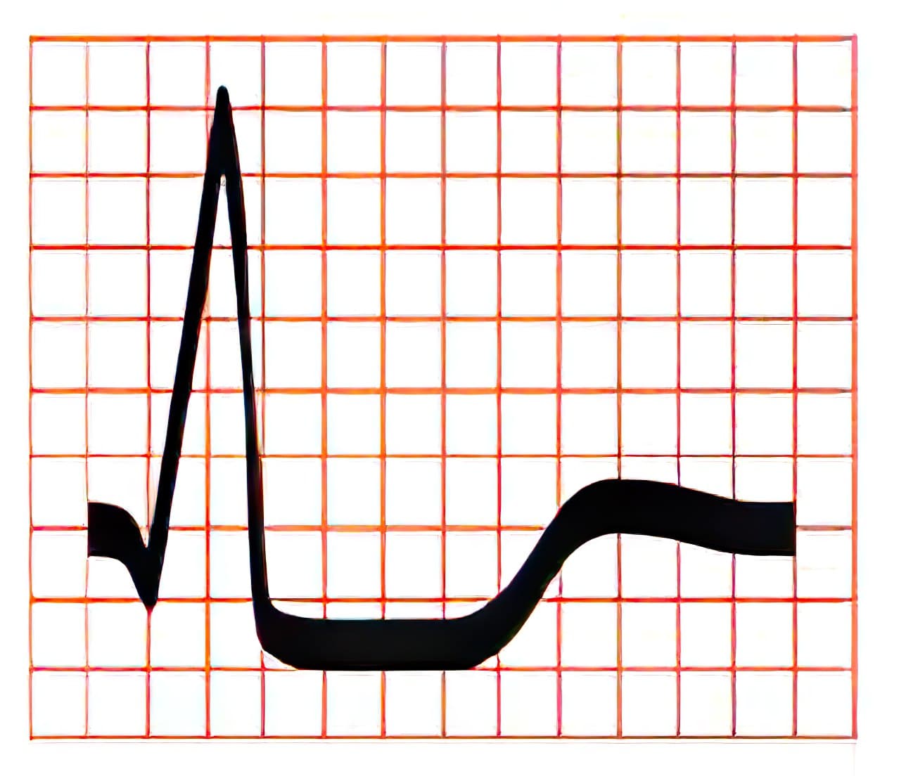 Subendocardial lesion ECG.
