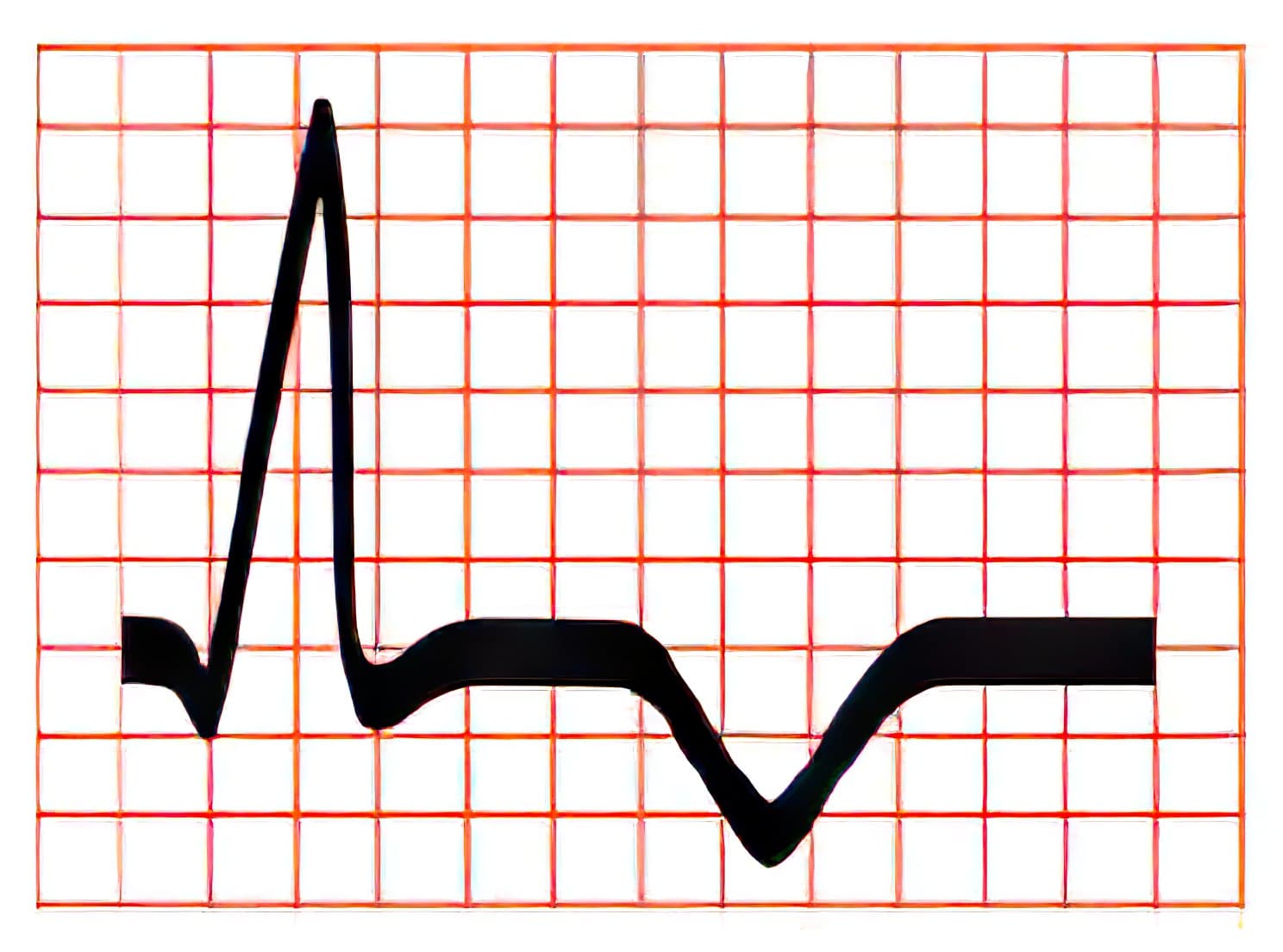 Subepicardial ischemia ECG.