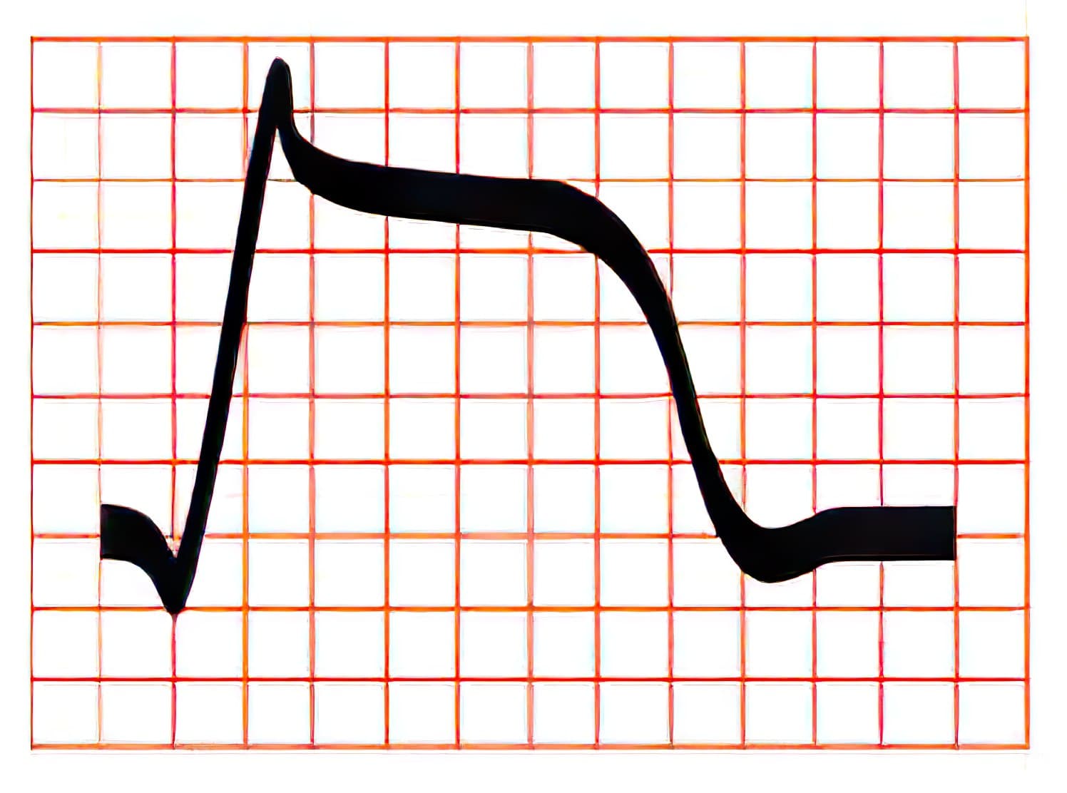 Transmural injury ST segment elevation.
