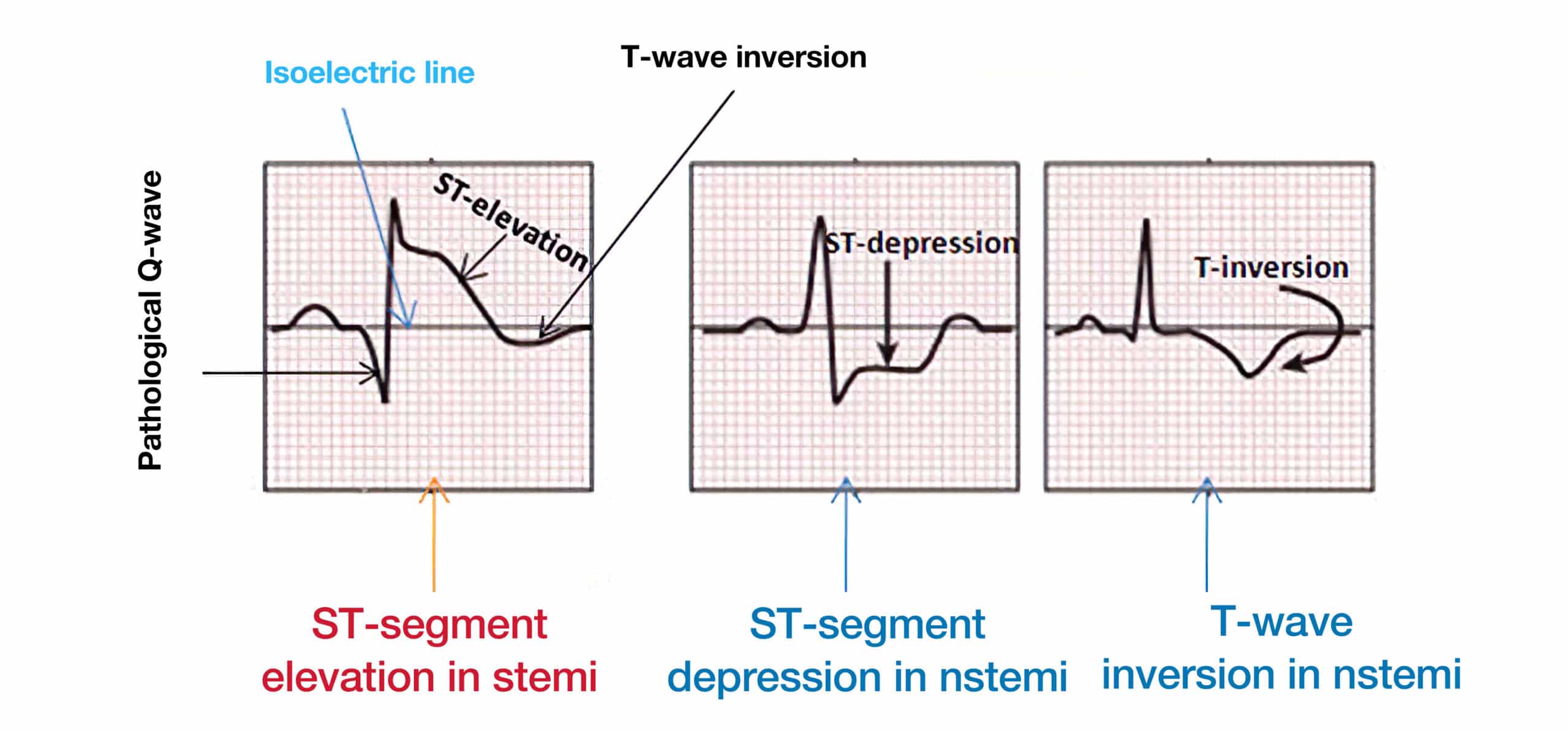 ECG changes in ACS.