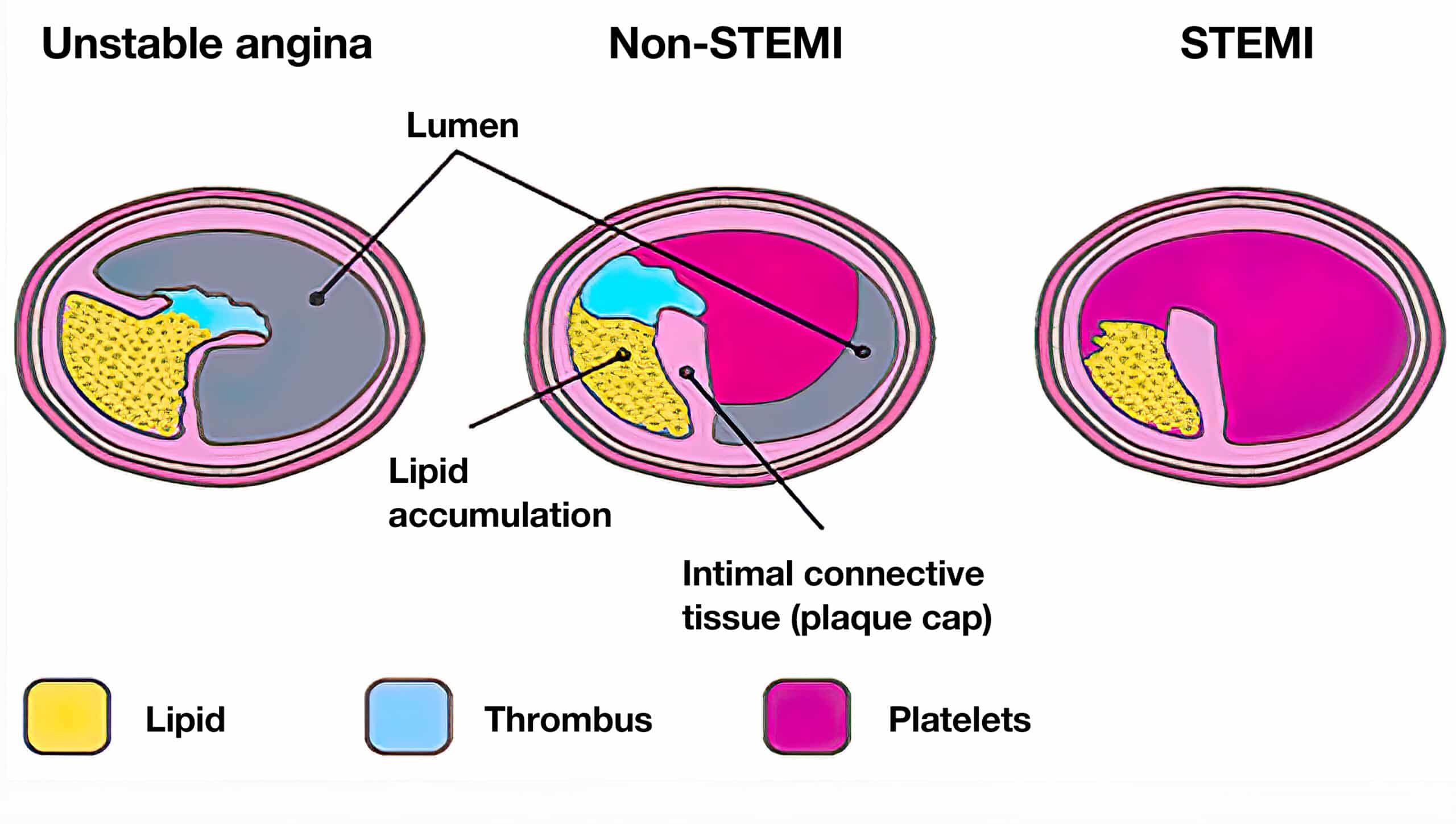 ECG findings determine ACS treatment strategy.