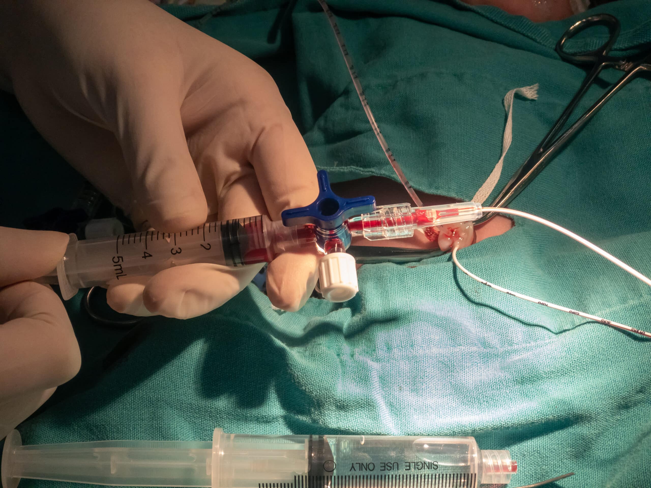 Medical clinician placing a syringe into an umbilical venous catheter.