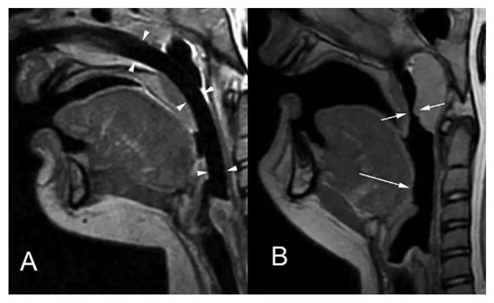 CT showing airway maintained with NPA.