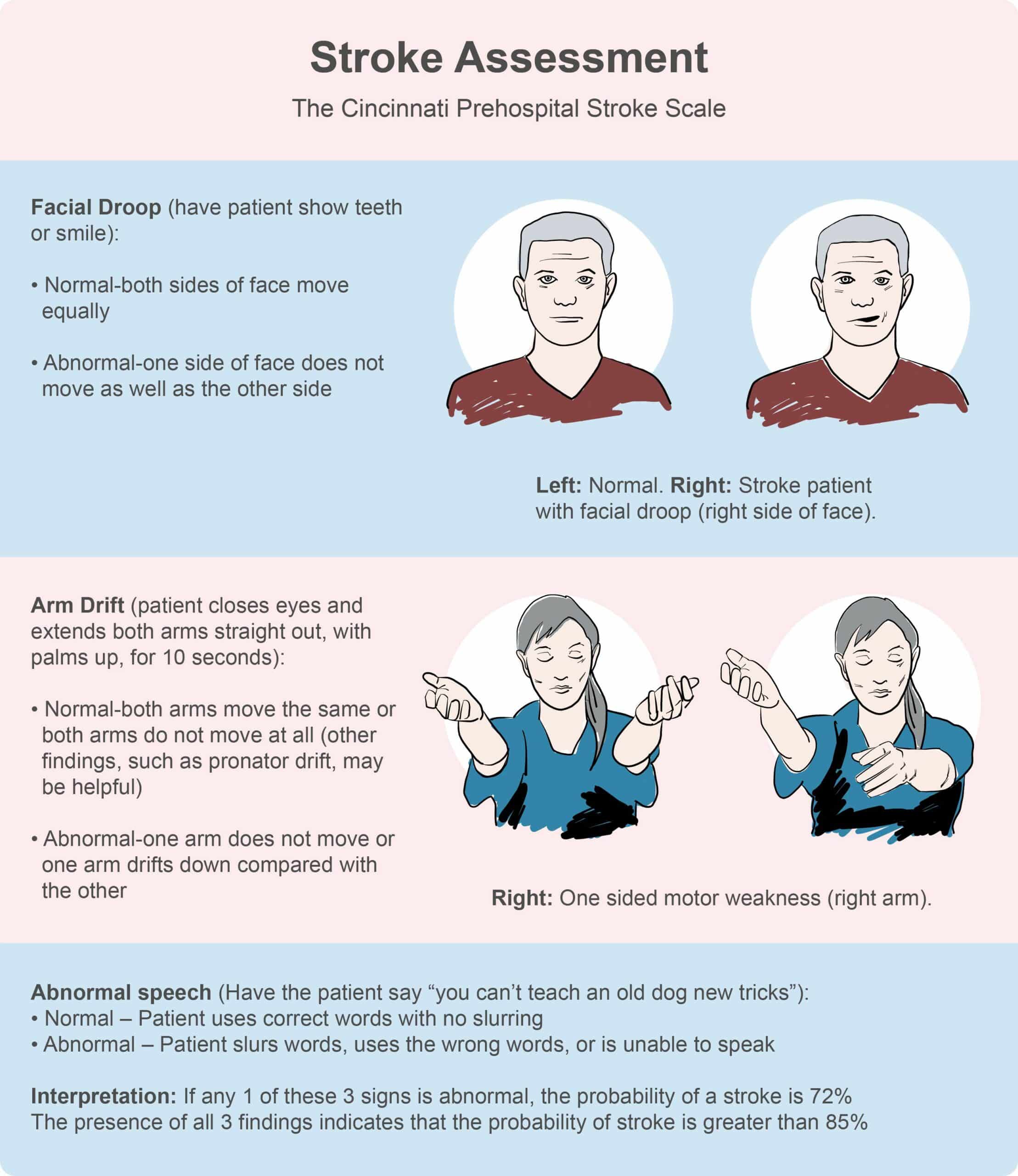 Cincinnati prehospital stroke scale.
