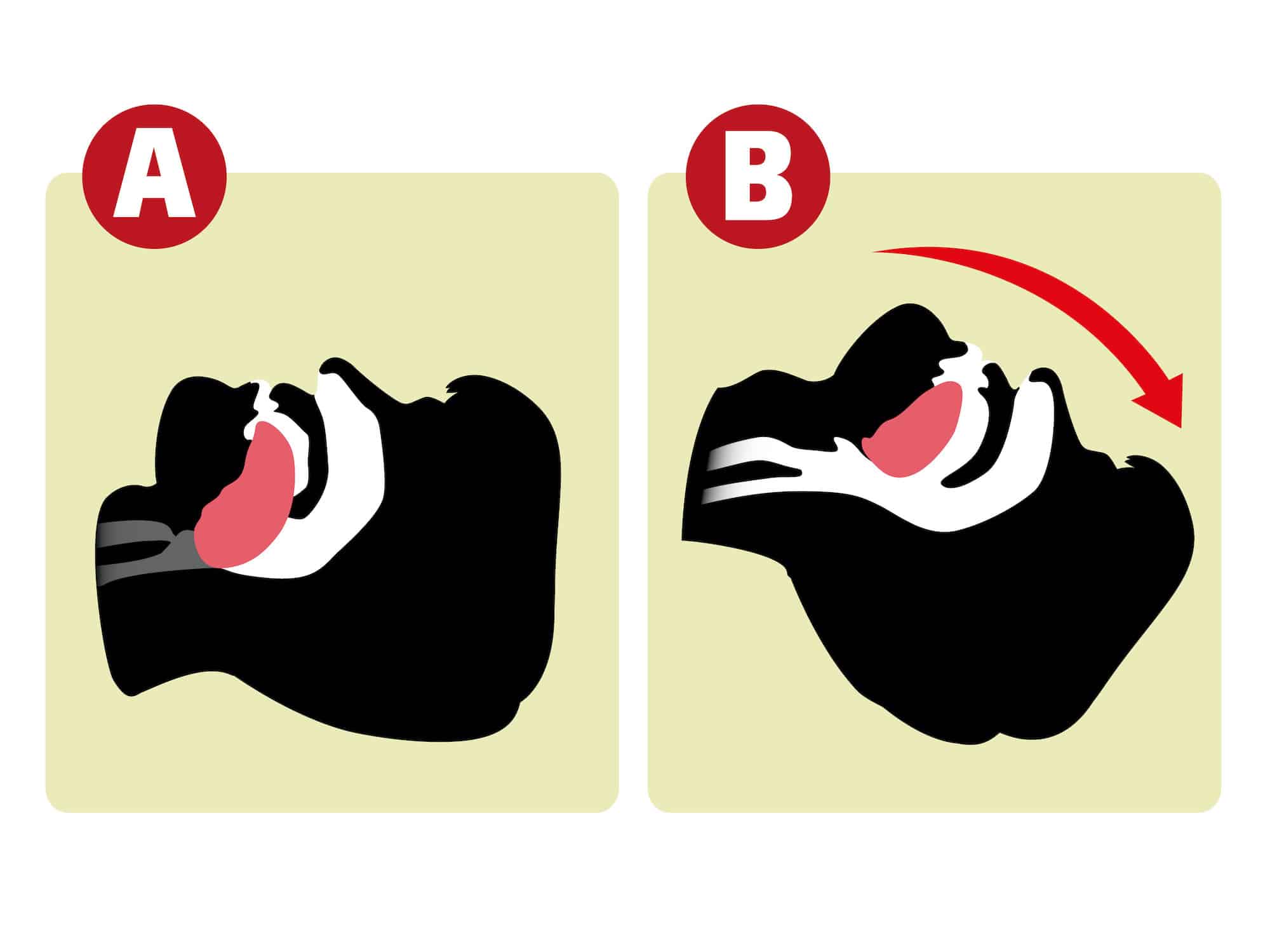 Head-tilt maneuver lifts tongue and opens airway.