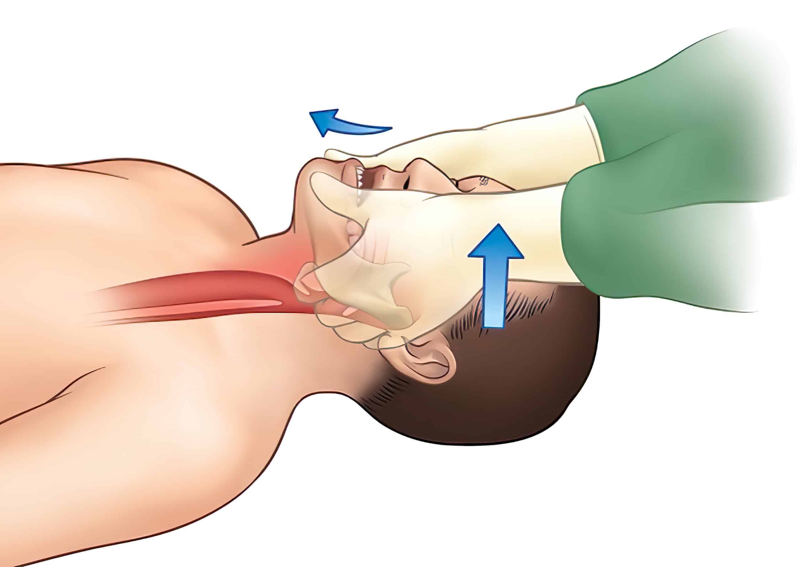 Jaw-thrust technique.