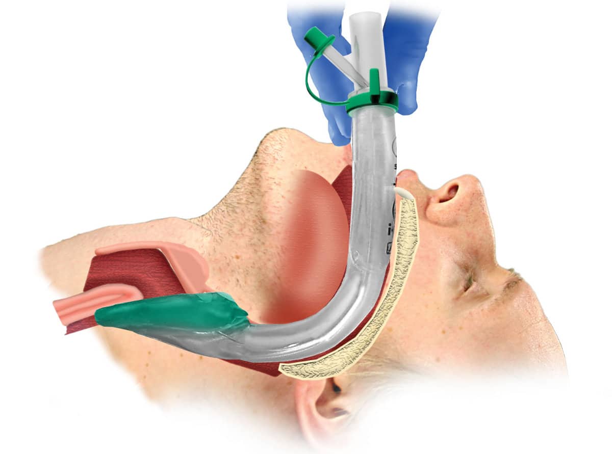 Laryngeal mask airway.