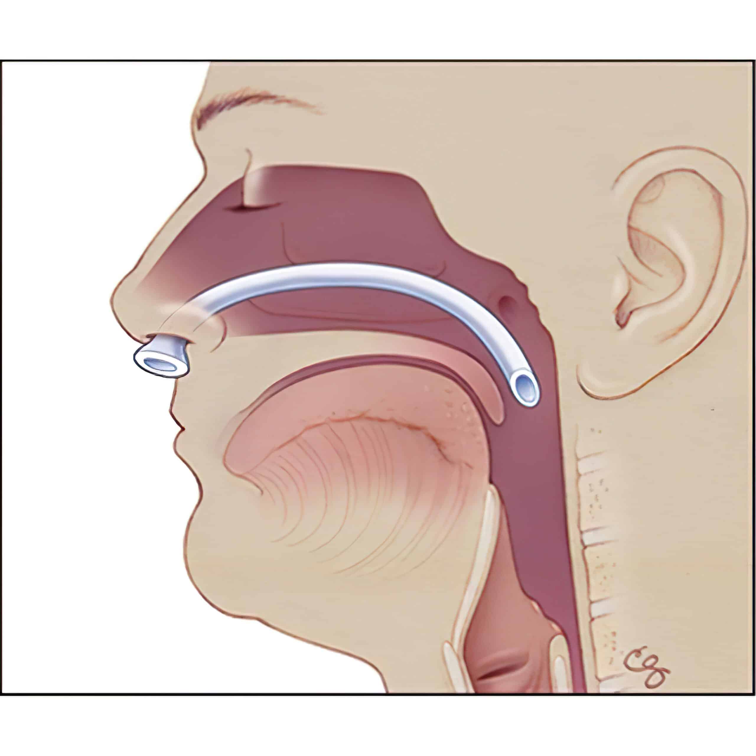 Measure NPA from nostril to earlobe or tragus.